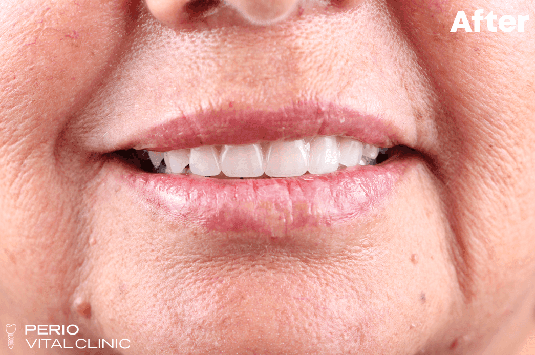 All-on-4 Dental Implants