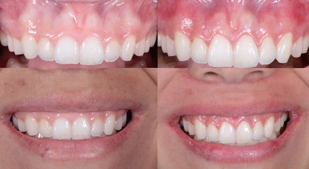 Esthetic Crown Lengthening