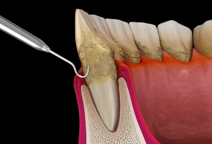 Gingival Tissue Graft