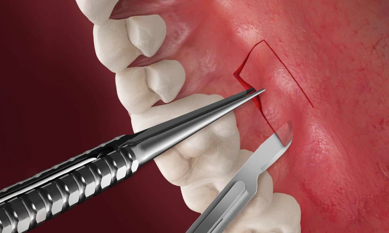 Connective Tissue Graft