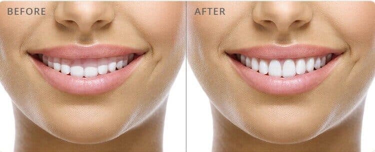Clinical Crown Lengthening