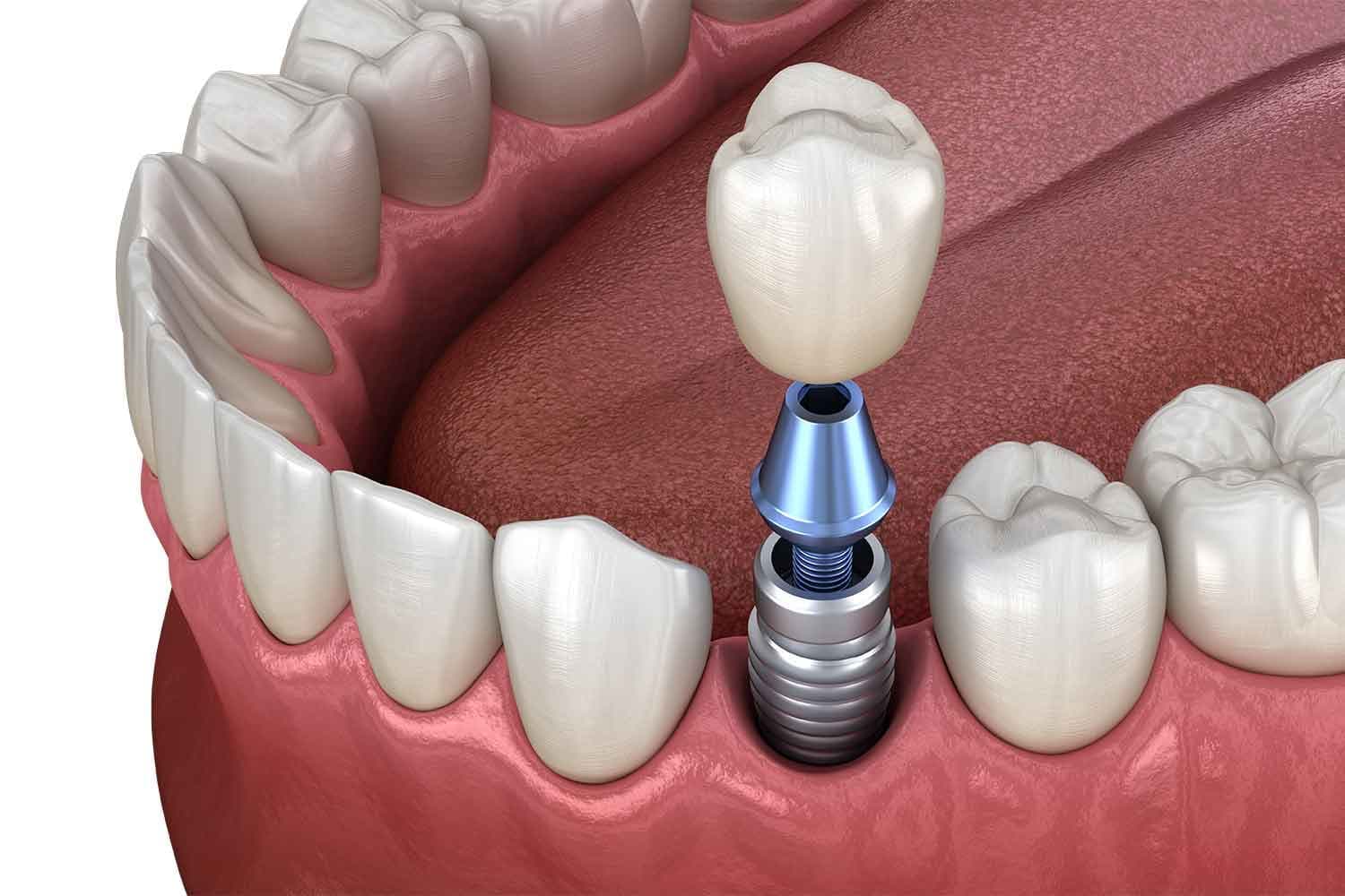 Implant Abutment