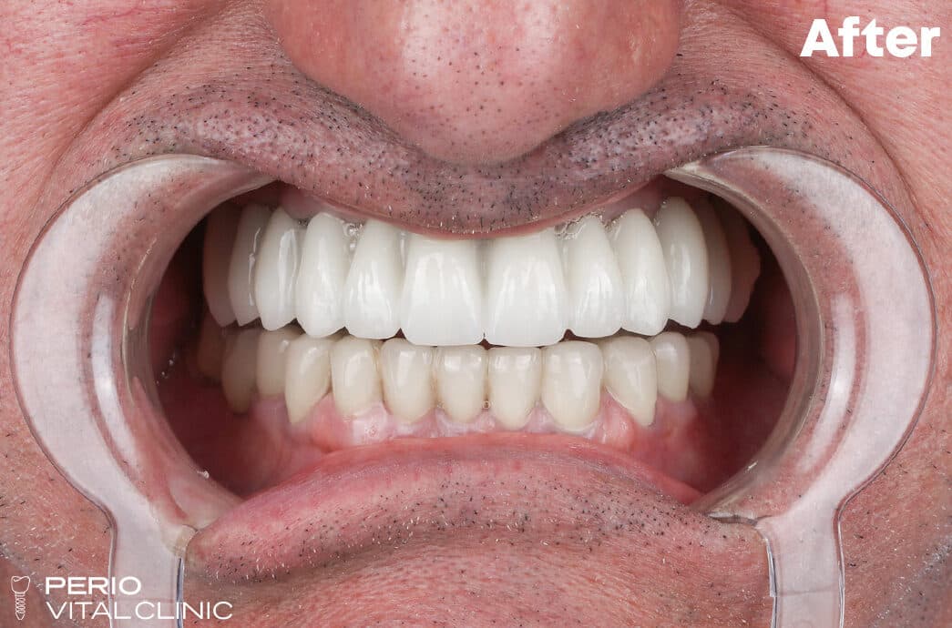 After — implant case