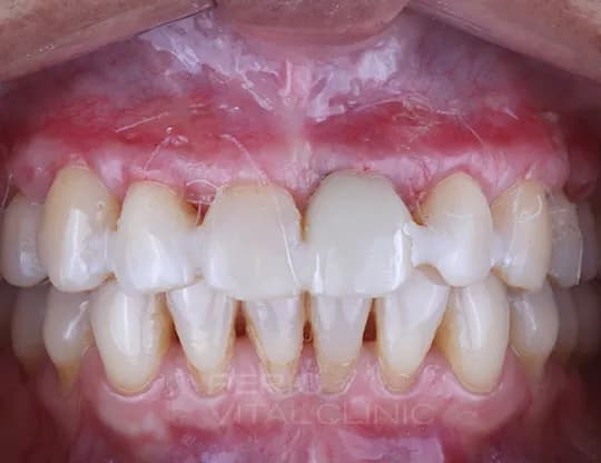 After — Gum Grafting