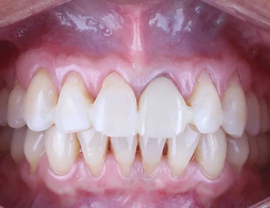 Before — Gum Grafting