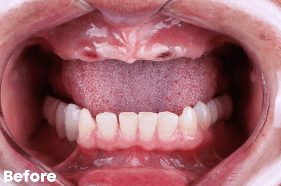 Before — implant case
