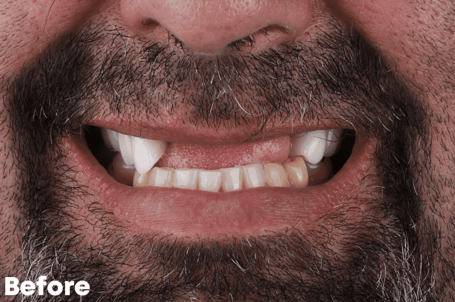 Before — implant case
