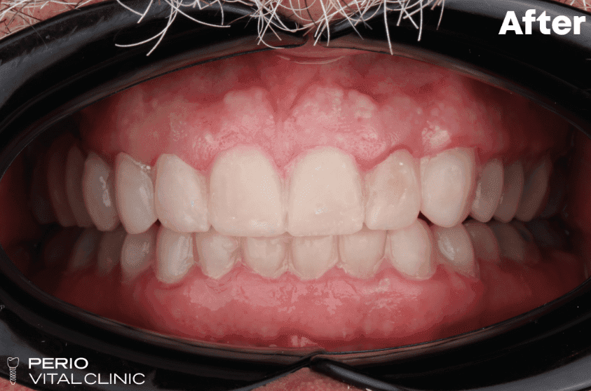 After — All-on-4 Upper Arch