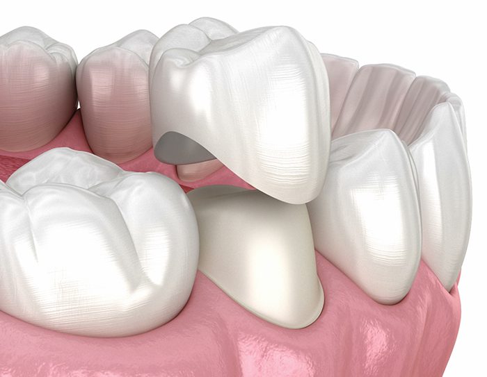 an illustration of a dental crown hovering over a damaged tooth